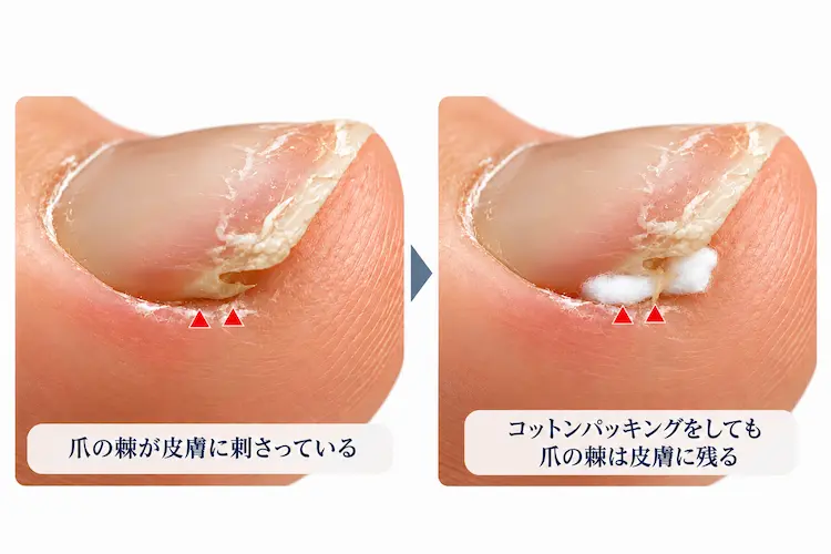 爪の棘とコットンパッキング比較