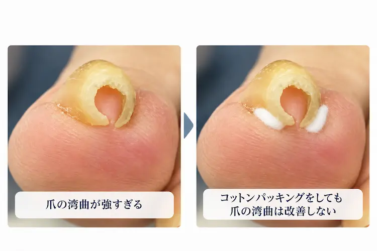強い爪の湾曲とコットン