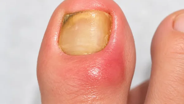 爪の根元が腫れて痛い・爪が伸びない｜後爪郭部爪刺し（レトロニキア）とは