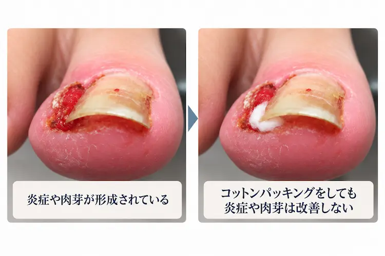 炎症と肉芽に対する処置比較