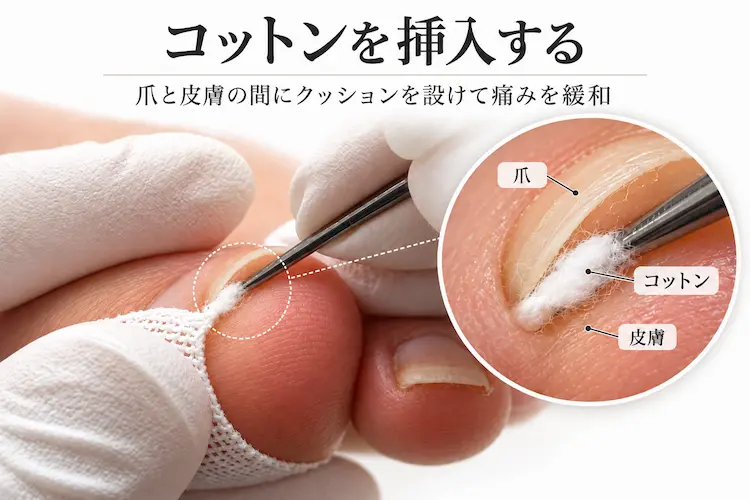 爪と皮膚の間にコットンを挿入する手順
