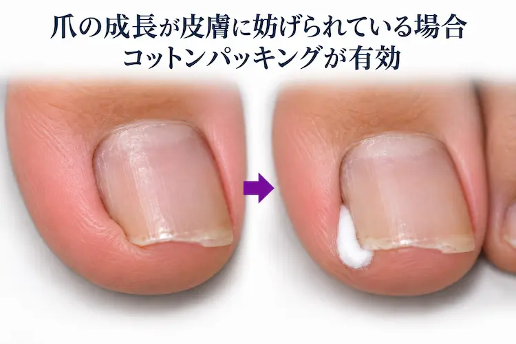 爪の成長を助けるコットンパッキング