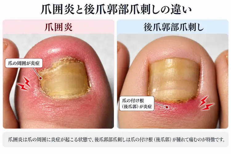 爪囲炎と後爪郭部爪刺しの違い