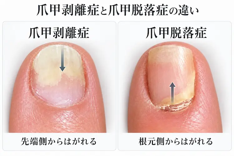 爪甲剥離症と脱落症の違い