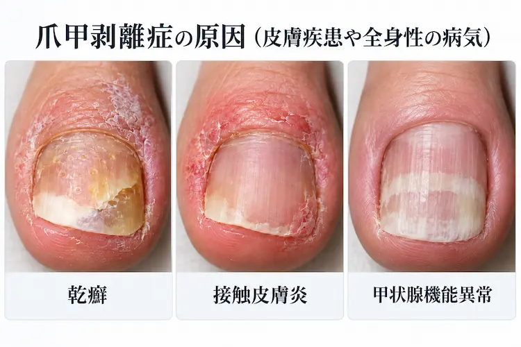 爪甲剥離症の原因と症例