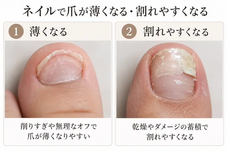 薄くなり割れやすい爪の原因