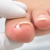 巻き爪・陥入爪のコットンパッキング法｜痛みを和らげる方法と注意点