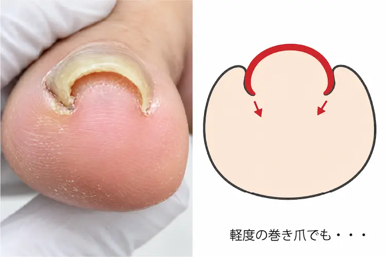 軽度の巻き爪でも痛い理由を説明したイラスト