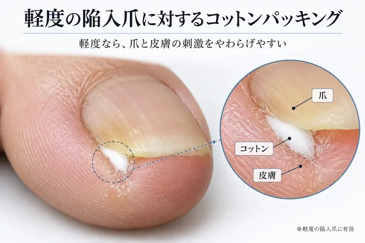 軽度の陥入爪 コットンパッキング解説