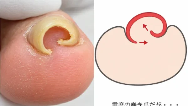 軽い巻き爪は放置しても大丈夫？痛みがなくても確認したい巻き爪の進行サイン