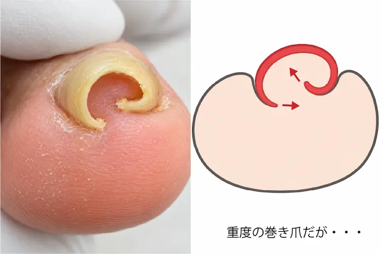 重度の巻き爪でも痛くない理由を説明したイラスト