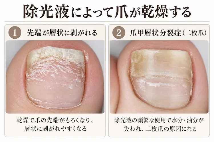 除光液による爪の乾燥と二枚爪