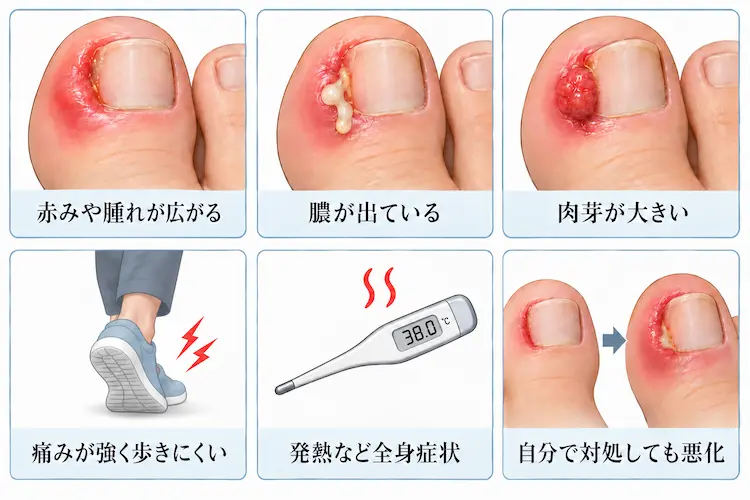 陥入爪の悪化サイン