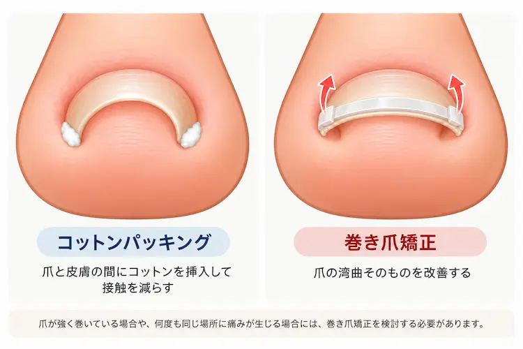 陥入爪ケア比較：コットンと矯正器具